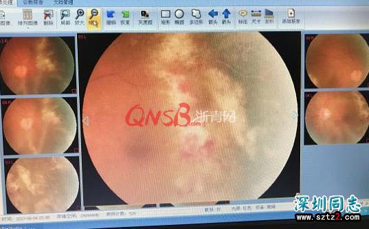 浙江一中年男子半年来视力持续下降 一查竟是艾滋病